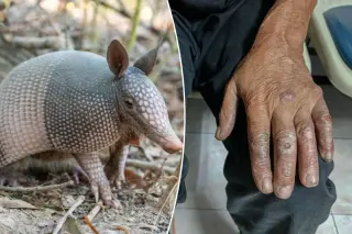 Armadillos Linked to Florida's Leprosy Surge