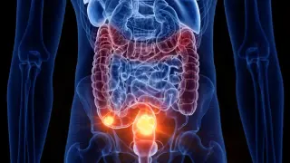 Colorectal Cancer Uptick in Under-50s Leaves Scientists Puzzled