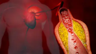 ApoB Testing Could Sharpen Cholesterol Therapy Decisions