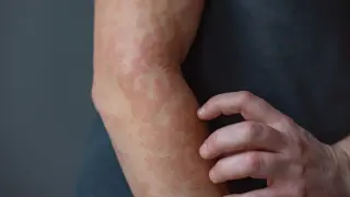 Keratin 16 acts as a brake on skin inflammation, hinting at new psoriasis therapies