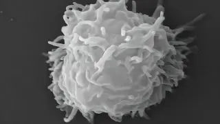 Rare Free-Living Amoeba Infection Triggers Fatal, Widespread Necrotic Lesions