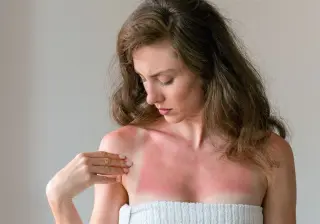 Tanmaxxing: the tanning trend that could damage your skin