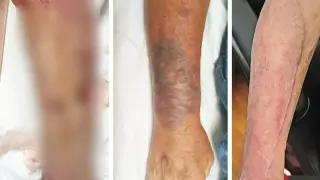 Warm Seas, Deadly Bacteria: A Florida Case of Vibrio vulnificus That Cost a Leg
