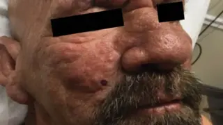 Florida’s leprosy cases hit a statewide record, with Central Florida as a hotspot