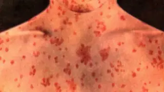 Iowa measles outbreak grows to 17 with Bloomfield exposure