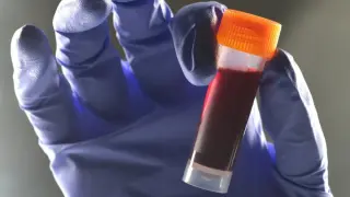 Umbrella Review Identifies Blood Type B as Sole Strong Predictor for Type 2 Diabetes