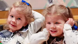 Non-invasive ultrasound treatment stabilizes TTTS in twin pregnancies