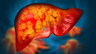 Late-Night Eating Linked to 36% Higher Risk of Fatty Liver Disease in 200,000-Person Study