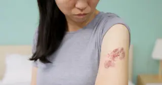 Epic Data Links Chickenpox Vaccine Era to Sharp Drop in Young Adult Shingles
