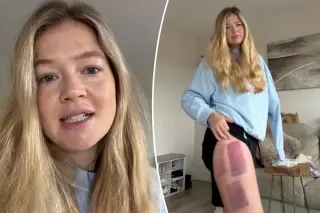 Leah Stewart’s skin graft fails three months after Coogee shark attack