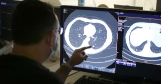 Pancreatic cancer drug shows early promise against lung cancer in NEJM trial