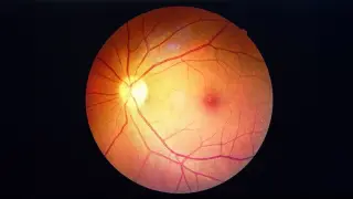 Retinal Damage May Begin Below Prediabetes Thresholds