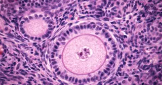 Postmenopausal Ovaries Remain Biologically Active, Linking Aging to Cancer Risk