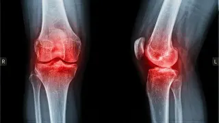 Tiny beads, big relief: a knee-pain breakthrough that could delay replacement