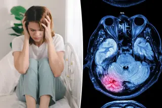 Study: Stroke Rates in Adults Under 55 Nearly Double Since 1993