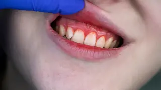 Omega-3 and aspirin show antibiotic-equivalent results in severe gum disease trial