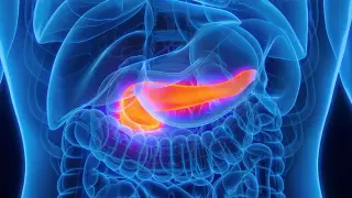 AI radiomics flags pancreatic cancer years before diagnosis