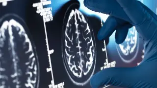 Shared brain network disruptions link schizophrenia and bipolar disorder, study finds