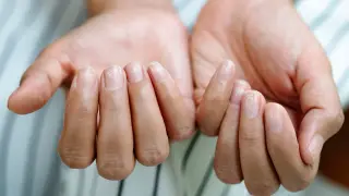 New Study Links GLP-1 Drugs to Higher Rates of Nail Detachment and Hair Loss