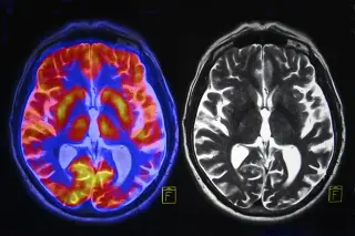 Long COVID Not Driven by Widespread Brain Inflammation; Emotions Centers Linked to Symptom Severity