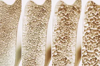 Vitamin K Orchestrates Bone Remodeling via GAS6 Signaling