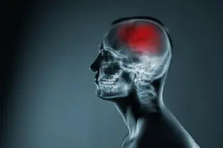 Tiny Vessel Damage Rewrites Lacunar Stroke Story