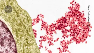 EBV-Driven CD4+ T Cells Link Epstein-Barr Virus to MS, Opening Immunotherapy Avenues