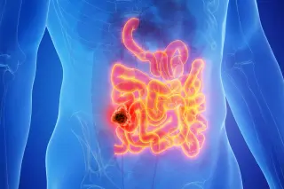 Pre-Surgery Immunotherapy Sparks Near-Three-Year Cancer-Free Remission in Bowel Cancer