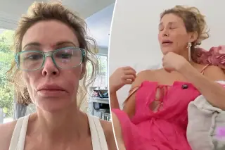 Brandi Glanville Teary Over GoFundMe for Ongoing Facial Health Battle