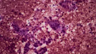 Tango Therapeutics reports 82% response rate for chemo-free pancreatic cancer combo at ESMO