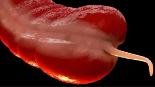Young Adults Face Surge in Rare Appendix Cancer, Scientists Scramble for Answers