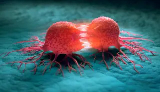 Under-50 Cancer Surge: Bowel and Ovarian Rates Climb in England