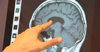 WHO: Modifiable factors could cut up to 45% of dementia risk
