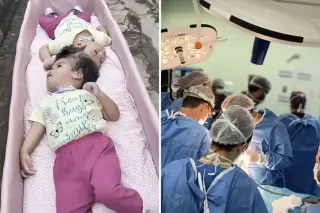 Two-Year-Old Brazilian Twins Die Moments After Final Separation