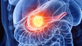 Pancreatic Cancer Vaccine Triggers Immune Response in 99% of Trial Patients, but Survival Data Lags