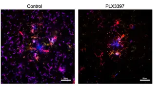 Alzheimer’s sleep breakthrough: brain immune cells offer new therapeutic angle