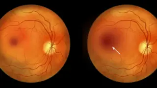 Ollin Biosciences bags $330M to push eye-disease therapy into Phase 3
