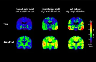 Florida Alzheimer’s Patient Sees Brain Plaques Clear After 18 Months on Kisunla Therapy