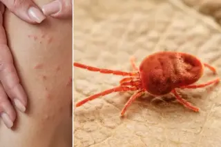 Chigger bites decoded: how tiny mites feast on your skin and trigger brutal itching