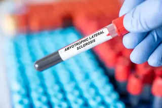 Blood Protein Panel Aims to Forecast ALS Onset Years Before Symptoms