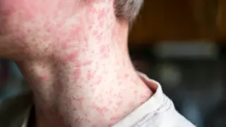 Public health alert after measles case visits Scottsdale Walgreens