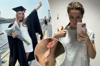 Rare parotid cancer surgery leaves UK student with partial facial paralysis