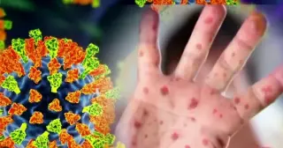 Delaware records second measles case in Kent County