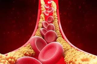 Remnant cholesterol: the hidden heart risk that could outpace LDL