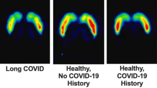 Long COVID Linked to 18% Drop in Brain Dopamine Nerve Endings, PET Study Finds