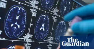 Social media hype around Alzheimer's blood tests risks anxiety and misdiagnosis