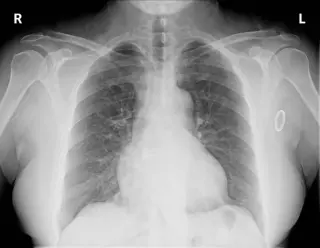 Rosuvastatin Restart Triggers Severe Rhabdomyolysis and Dialysis-Dependent Kidney Failure in Post-Stent Patient