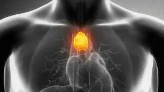 The Thymus Dilemma: Does Removing a Small Gland Raise Cancer Risk in Adults?