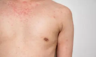 Measles Isn’t Just a Kid’s Problem: Adults Now Face Real Risk