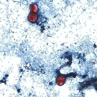 Cyclospora outbreak shifts focus to the D.C. region as cases rise